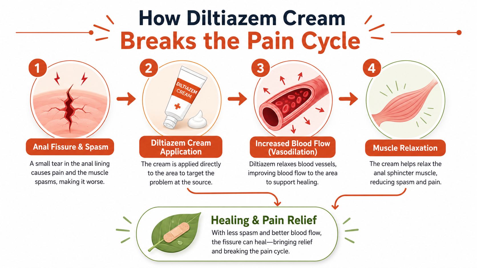 A four-step infographic illustrating how Diltiazem cream treats an anal fissure to provide pain relief.