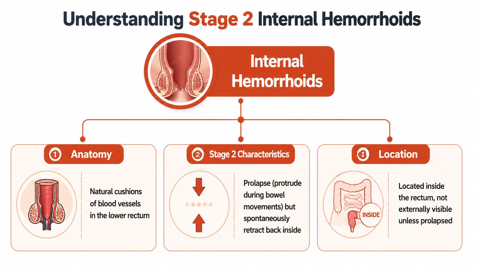 An infographic detailing stage 2 internal hemorrhoids, including anatomy, characteristics, and location within the lower rectum.